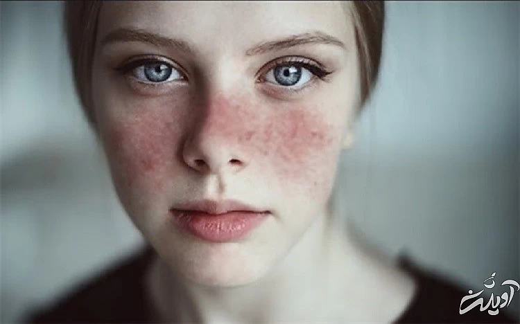 راهنمای جامع لیزر موهای زائد